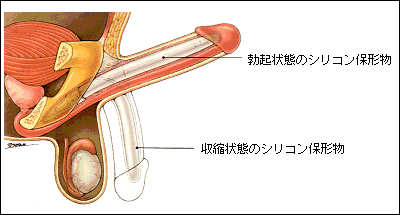 先天性陰茎弯曲症（屈曲・弯曲ペニス） | 帝京大学泌尿器科アンドロロジー診療