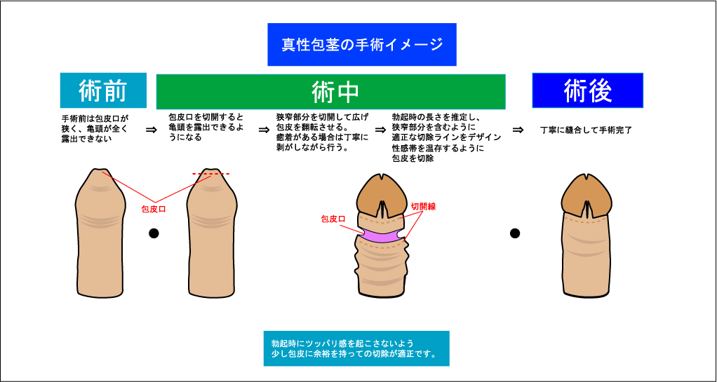 包茎とは・包茎の種類・包茎は病気なの？ – メンズ形成外科 |