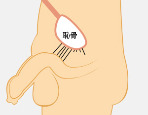 シリコンボール｜薄毛・AGA治療・ED治療薬処方｜美容外科形成外科 川崎中央クリニック・メンズサイト