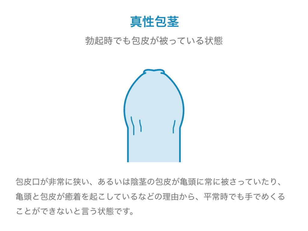 コンドームが破れた！ 妊娠の確率と2つの対処法【医師監修】｜「マイナビウーマン」