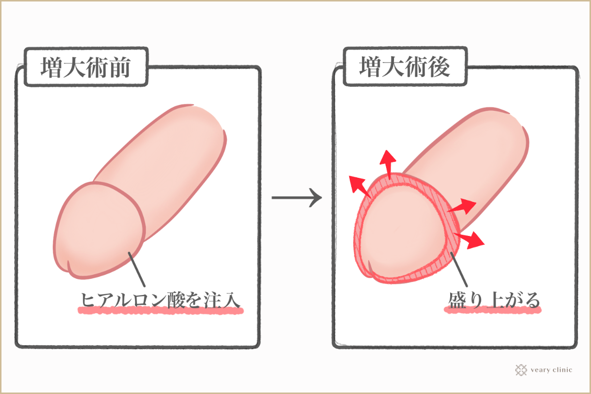 亀頭増大術・ペニス増大について｜MSクリニック