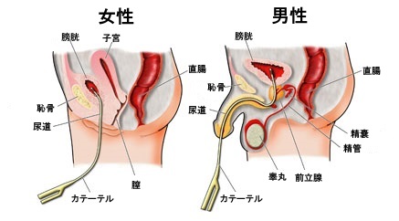 Amazon.co.jp: Tibemi 尿道プラグ