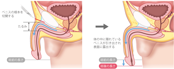 皮伸ばし (かわのばし)とは【ピクシブ百科事典】