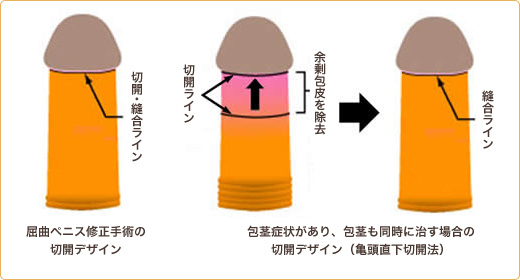 屈曲・湾曲ペニス修正｜名古屋中央クリニック - 泌尿器科・形成外科